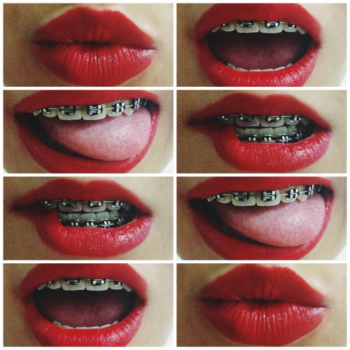 lips with braces